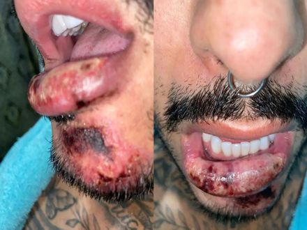 O TEMPO: Modelo de BH fica com boca deformada e feridas após harmonização facial o tempo 2