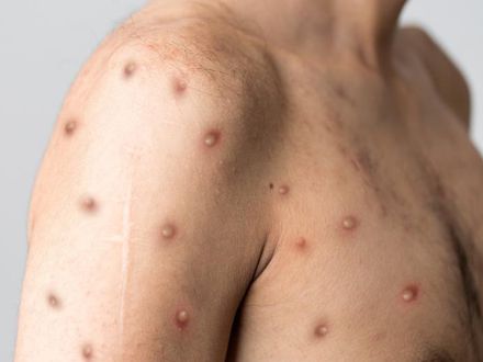 Divinópolis notifica o primeiro caso suspeito da “Varíola dos Macacos” - Monkeypox; jovem de 15 anos varíola dos macacos 2