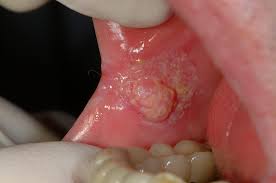 Ação gratuita para rastreio de câncer de boca e pele acontece na próxima semana dentista