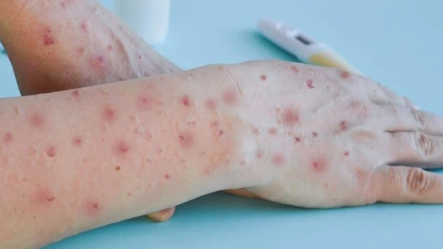 Ministério da Saúde negocia compra emergencial de vacinas contra novo surto de mpox 8xfwzhz2f19t8owyyweh1oysr
