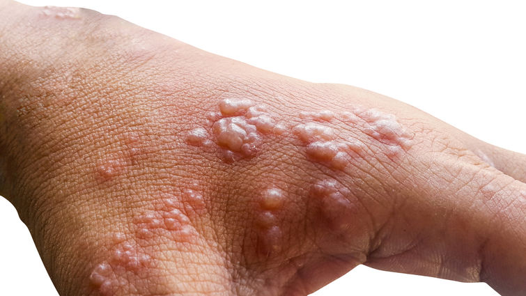 Brasil registra 945 casos de Mpox em 2024, superando total de 2023 Skin infected Herpes zoster virus on the arms