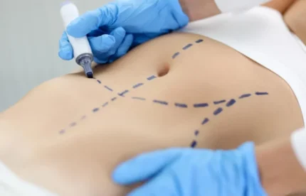 Capital brasileira das cirurgias plásticas baratas: UBÁ-MG tem pacote “X-Tudo”, seios, barriga e glúteo, a preço módico