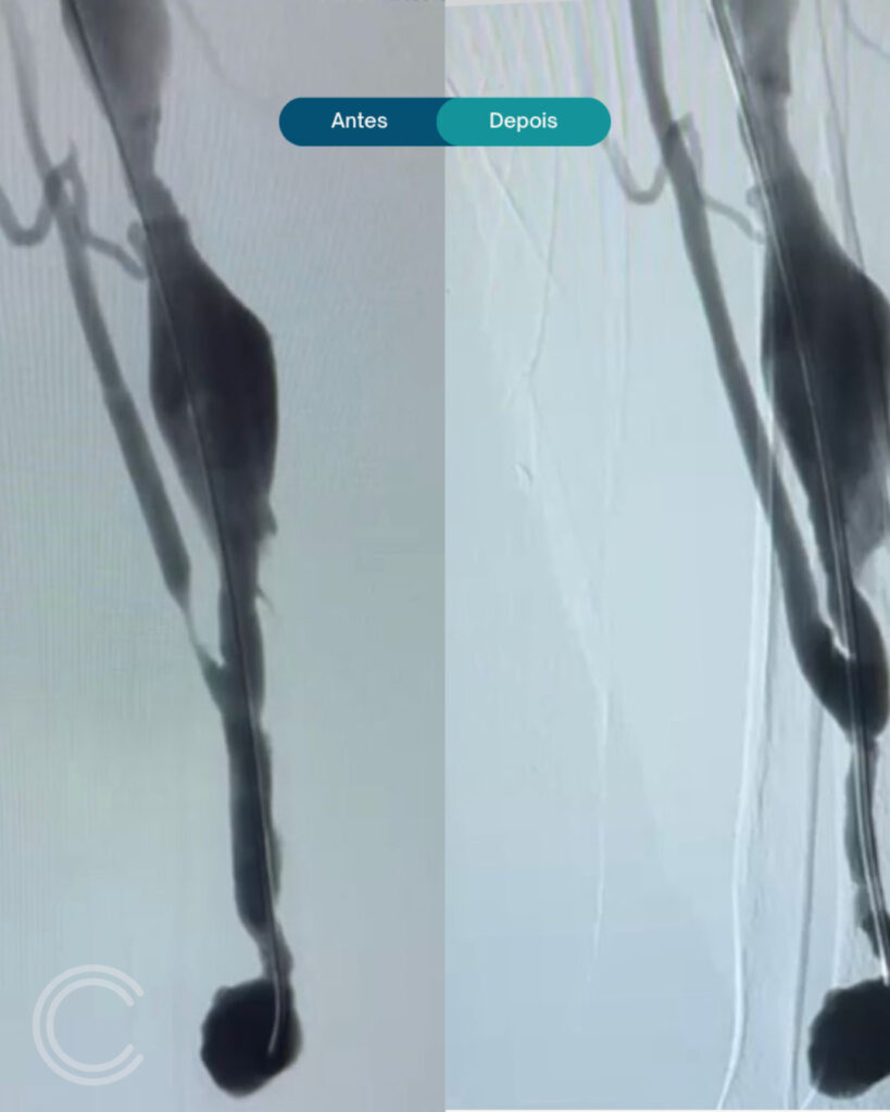 CSSJD realiza com sucesso o primeiro procedimento de recuperação de fístula arteriovenosa do projeto “FAVorecer” IMG-20251103-WA0035