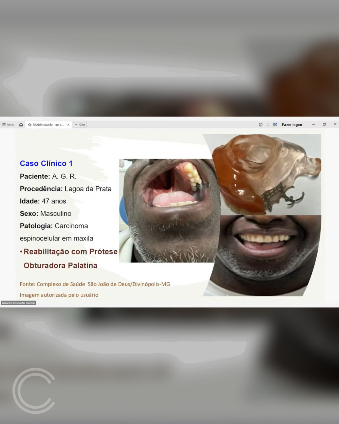 CSSJD se consolida como referência nacional em prevenção e reabilitação de câncer de boca após destaque em webinar do Ministério da Saúde