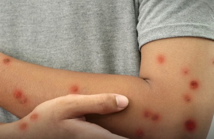 ALERTA DE SAÚDE: Minas Gerais confirma os primeiros casos de mpox em 2026; saiba onde foram registrados