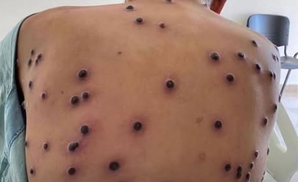 Mpox em ascensão: Velocidade de transmissão do vírus monkeypox coloca o Brasil em estado de atenção