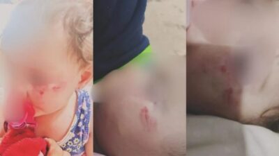 Mãe registra BO após bebê ser mordida por colega em escola de Divinópolis: “Isso não pode ser normal