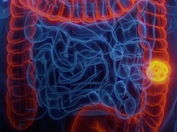 SUS amplia rastreamento de câncer de intestino e inclui novo exame para pessoas de 50 a 75 anos image (1)